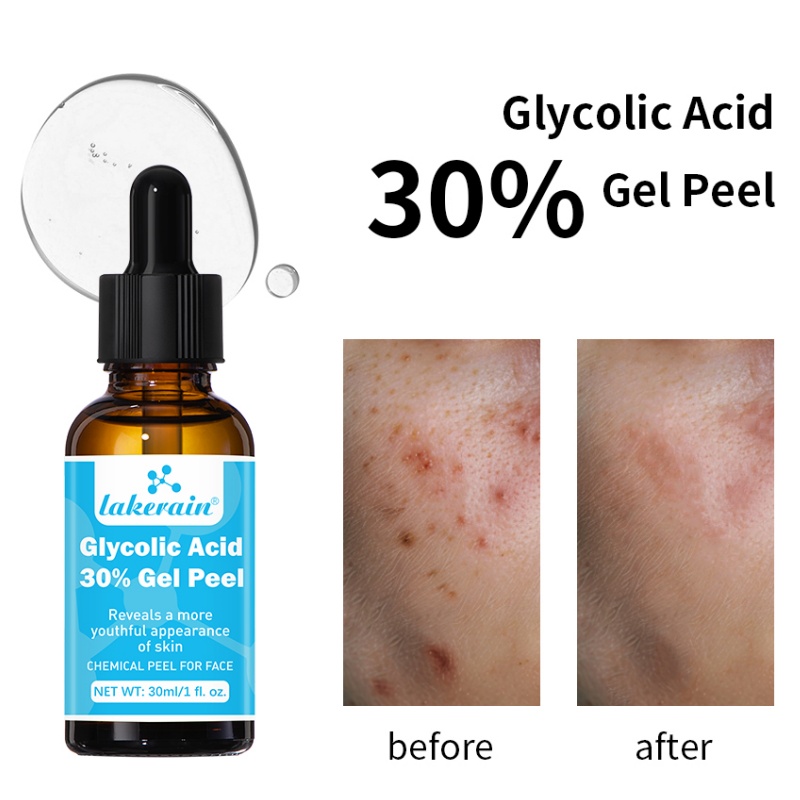 30 % Glykolsäure-Peeling-Gel,  – Lactic Acid Toner Bewertung und Preis